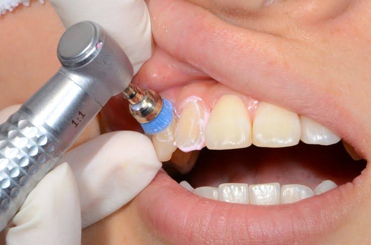 Teeth Cleaning product image
