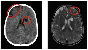 Si tratta della comparsa acuta di deficit neurologici dati dalla rottura di. Buchi In Testa