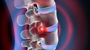 4) how to sleep with a thoracic herniated disc? Herniated Disc Treatments