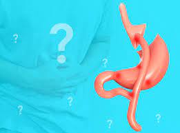 Gastrik dumping sendromu, ameliyat edilen hasta normal diyete geri döndüğünde daha belirgin hale gelir. Dumping Sendromu Nedir Dr He Obesity Clinic
