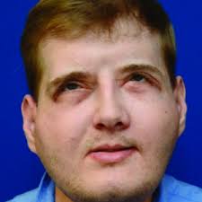 US firefighter feels 'normal' year after face transplant