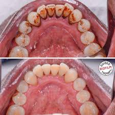 Enamel, the strong outer coating that covers the other layers of the teeth, has microscopic holes in it. Airflow Tooth Stain Removal Buckden Dental Clinic Cambridgeshire Dentists St Neots And Buckden