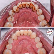 Grip the floss tightly in each hand, and move the floss up and down between each tooth. Airflow Tooth Stain Removal Buckden Dental Clinic Cambridgeshire Dentists St Neots And Buckden