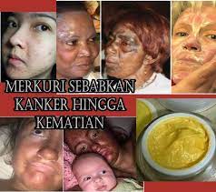Konsumsilah vitamin e 150 iu per hari. Sering Minder Karena Bekas Jerawat Yuk Coba Ikuti 7 Tips Cara Hilangkan Jerawat Dengan Bahan Alami Mantra Sukabumi