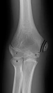 Lateral epicondylitis (tennis elbow) is a painful condition of the elbow due to its overuse or strenuous activity that causes pain in the elbow and arm. How To Avoid Missing A Pediatric Elbow Fracture Acep Now