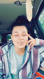 Broke my jaw. #foryou #fyp #foryoupage #jaw #brokenjaw #broken