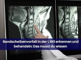 Bandscheibenvorfall In Der Lws Erkennen Und Behandeln