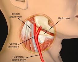 Carotid Sinus Massage Hypersensitivity Syndrome