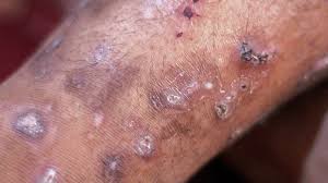 Image result for scabies human bites