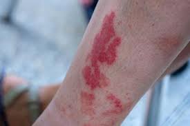 Image result for Vasculitis