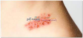 كيف تنتقل عدوى الحزام الناري. Ù…Ø¹Ù„ÙˆÙ…Ø§Øª Ø·Ø¨ÙŠØ© Ø¹Ù† Ù…Ø±Ø¶ Ø§Ù„Ø­Ø²Ø§Ù… Ø§Ù„Ù†Ø§Ø±ÙŠ Ù…Ø±ÙƒØ² Ù…Ø³Ø§Ø¬ Ø§Ù„Ø­Ø²Ø§Ù… Ø§Ù„Ù†Ø§Ø±ÙŠ Ø§Ù„Ø§Ø¹Ø±Ø§Ø¶ Ø§Ù„Ø§Ø³Ø¨Ø§Ø¨ ÙˆØ·Ø±Ù‚ Ø§Ù„Ø¹Ù„Ø§Ø¬