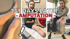 Learn more about footless jo's favorite products. 2 Years An Amputee Revisiting My Amputation Decision Youtube