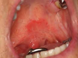 Image result for Erythroplakia roof of mouth