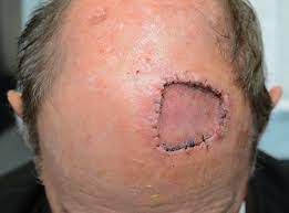 Post Op Wound Healing Care Dr Stretch
