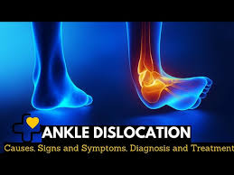 Image result for Ankle Dislocation