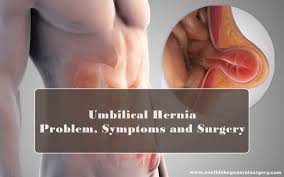 After birth, the umbilical cord is no longer necessary, and the opening in the abdominal muscles closes as the baby matures. Umbilical Hernia Problem Symptoms And Surgery Southlake General Surgery