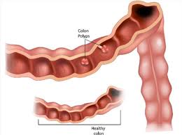 Kanser usus (colon cancer) adalah antara 10 kanser yang paling kerap berlaku di malaysia. Orang Muda Pun Boleh Kena Kanser Kolon Kalau Masih Lakukan 6 Perkara Ini Columbia Asia Hospital Malaysia