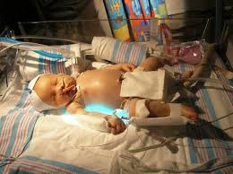 Image result for Kernicterus