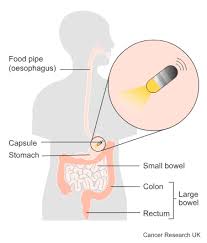 Image result for Wireless Capsule Endoscopy