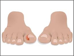 I have two broken toes, 9 blisters, and an ear infection, but i don't care. Cara Merawat Kaki Cagu Kuku Cekam Ibu Jari Kaki Bengkak Dan Sakit