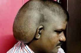 Primary brain tumors begin within the brain. World S Largest Brain Tumor Removed From Man After 20 Years