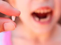 Rotura De Los Dientes De Leche Que Hacer Mi Bebe Y Yo