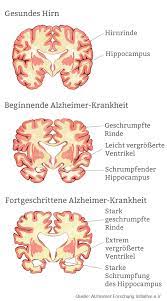 Doctors can diagnose possible alzheimer's dementia, probable alzheimer's dementia, or some other problem causing memory complaints. Alzheimer Ursachen Symptome Verlauf Pflege De