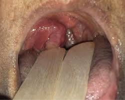 Image result for Peritonsillar Abscess