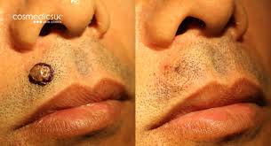 Places?i want to remove about 5 beauty marks/ moles from my face. Mole Removal Clinic Leading Uk Mole Clinic Cosmedics Skin Clinics