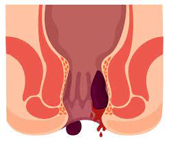 Hemorrhoids Treatment Chicago | Chicago Vein Institute