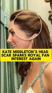 Kate Middleton's head scar sparks royal fan interest again#news #royal...