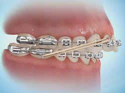 Common Appliances Procedures - Santa Cruz Ca Dental Braces Orthodontic Rubber Bands Orthodontics