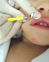 Beetlejuice treatment for molluscum … перевести эту страницу. Molluscum Contagiosum An Update And Review Of New Perspectives In Eti Ccid