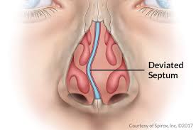 Deviated septum