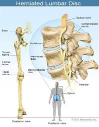 A backbone or core network is a part of a computer network which interconnects networks, providing a path for the exchange of information between different lans or subnetworks. Sciatica Sciatic Nerve Location Treatment Causes Pain Relief