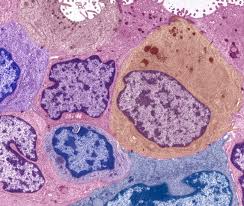 Many people find out that they have breast cancer after routine screening with a mammogram. Mri Yields Most Concordant Breast Cancer Tumor Size Assessment Cancer Therapy Advisor