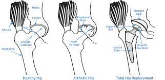 We did not find results for: Hip Replacement Surgery Procedure Types And Risks Hss