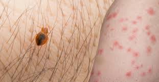 Image result for bedbug bites look like