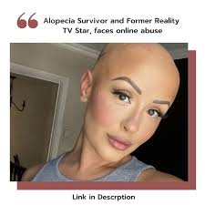 Alopecia World (@alopeciaworld) • Instagram photos and videos