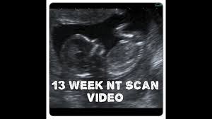 How accurate is nuchal translucency? 12 13 Week Nt Scan Ultrasound Video Youtube