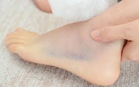 I have a large circular bruise on the top of my foot that hurts when i press it. Is It Ok To Walk On A Sprained Ankle
