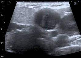 When ultrasound is performed on a patient with nodular goiter, or a patient with a history of thyroid cancer, finding a prominent lymph node with a rounded shape (long/short axis ratio < 2) and absent hilar line warrants further evaluation of the node (figs. Imaging Of Neck Lumps The Bmj
