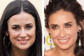 Demi moore broke her silence on the fendi catwalk where her face appeared unrecognisable. Demi 2007 Left 2011 Right Celebrity Plastic Surgery Demi Moore Plastic Surgery