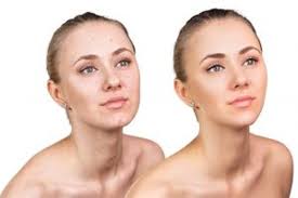 Acne Scar Treatment San Mateo, San Francisco