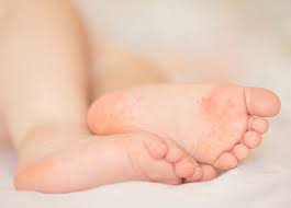 Elle survient par petites vagues épidémiques, du printemps au début de l'automne. Syndrome Ou Maladie Pieds Mains Bouche Sante Sur Le Net