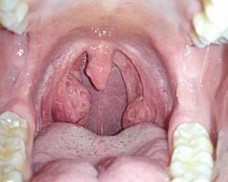 Image result for Tonsillolith