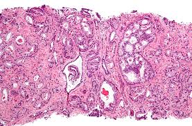 This term implies careful observation of the tumor over time, with the intention of treatment for cure if there are signs of cancer progression. Old Drug Gets New Trick For Prostate Cancer Treatment Stat