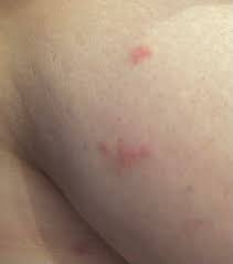 Red itchy spots on the side of breast? : rbigboobproblems
