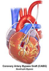 Coronary Artery Bypass Surgery Coronary Arteries Arteries Coronary