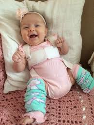 Pavlik Harness Care Caring For A Baby In A Pavlik Isn T Easy Here Are A Few Tips That I Have To Offer From My Own Experience Hip Heupdysplasie Baby Medisch